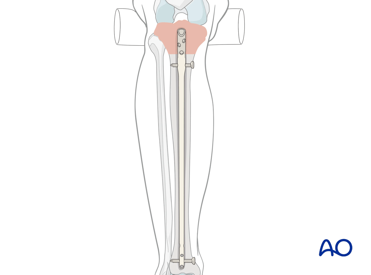 Proximal tibia fractures: Intramedullary nailing