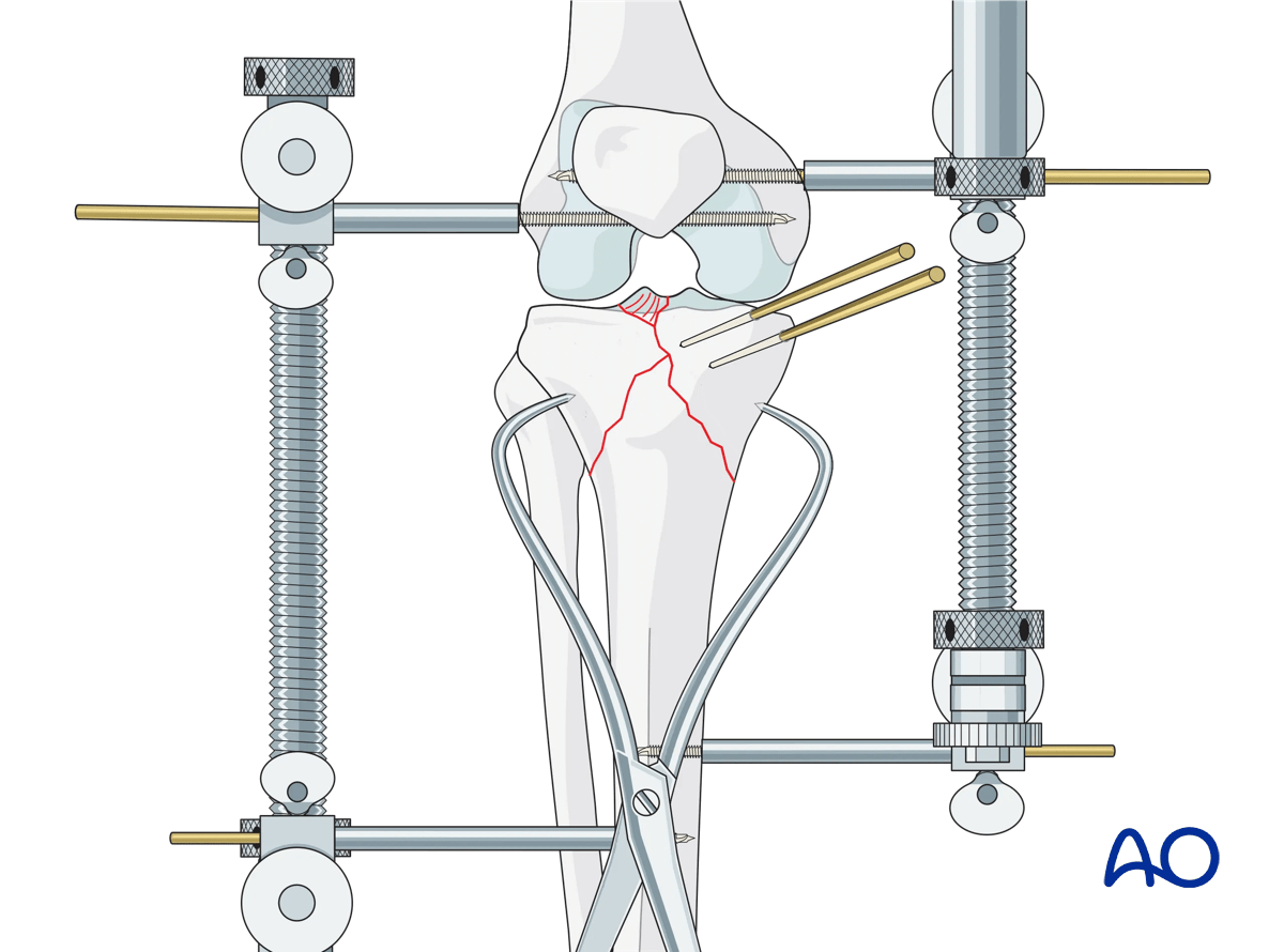 Proximal tibia - Complete articular fracture with fragmentary medial plateau: preliminary reduction