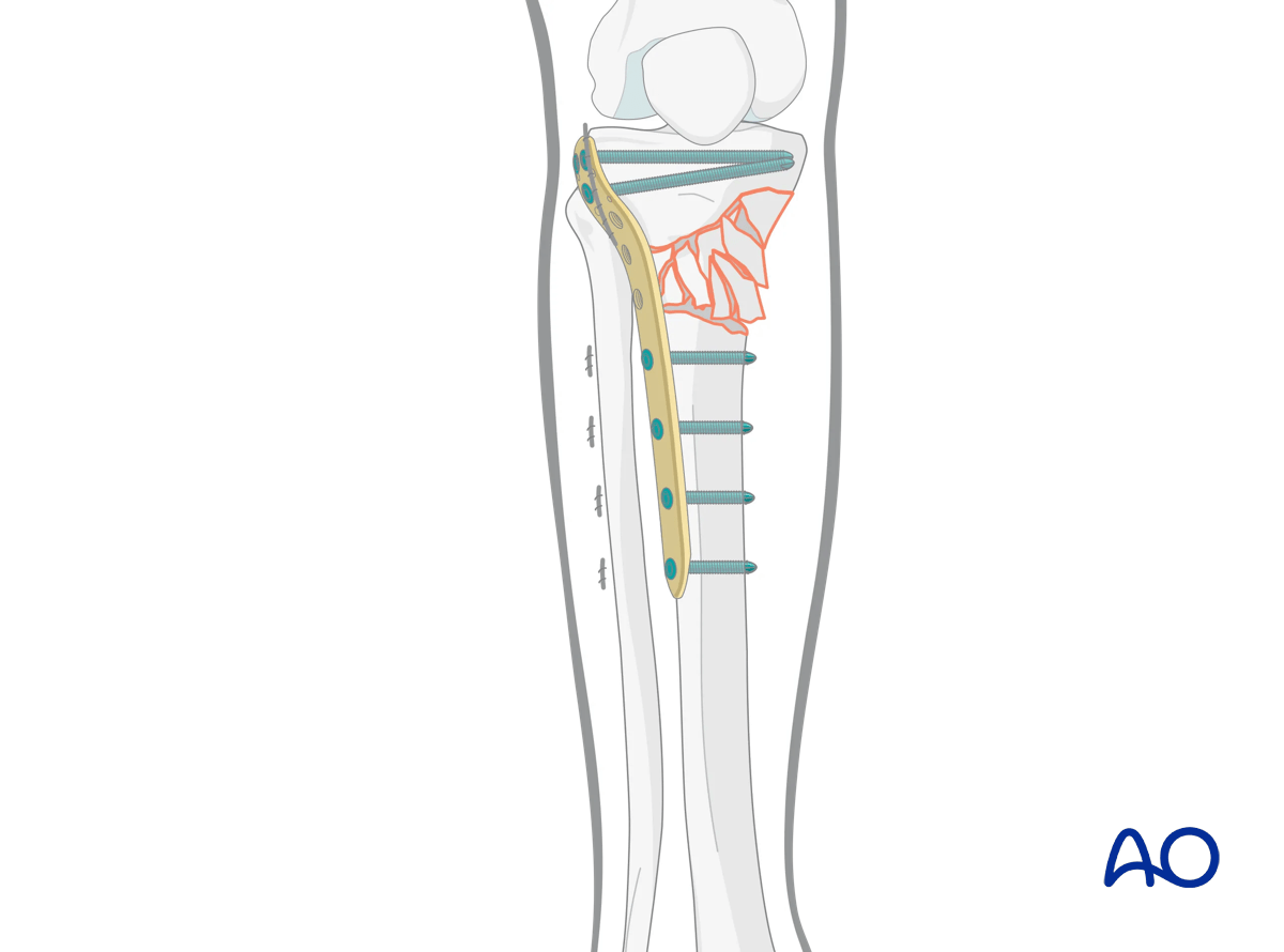 Proximal tibia: Wedge or multifragmentary extraarticular fracture Angular stable plating – finalized reduction and screw placement