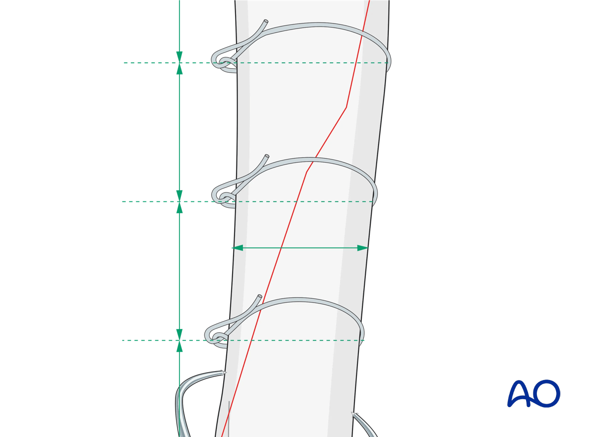 Cerclage of a long oblique fracture