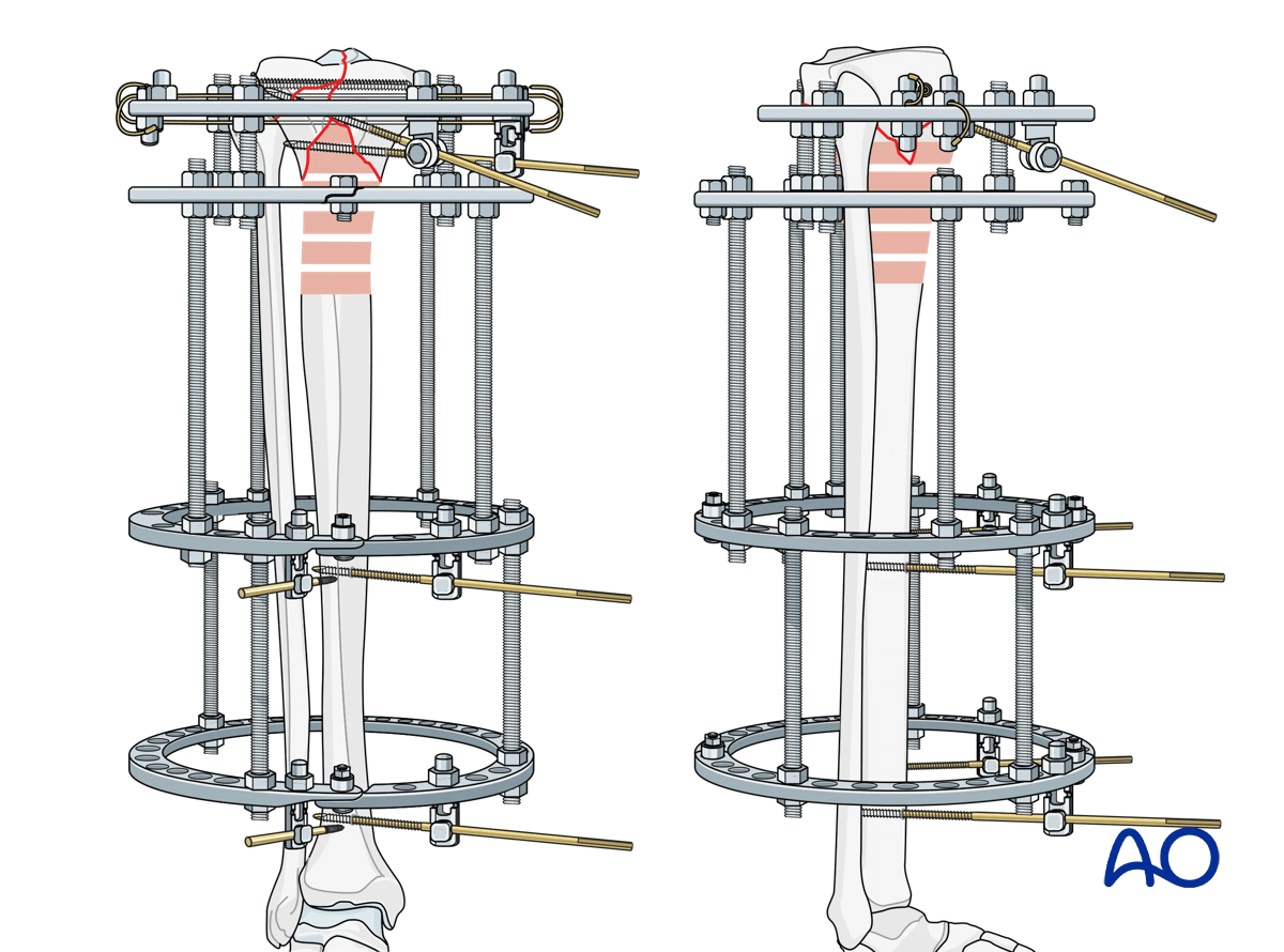 Proximal tibia fracture – ring fixation