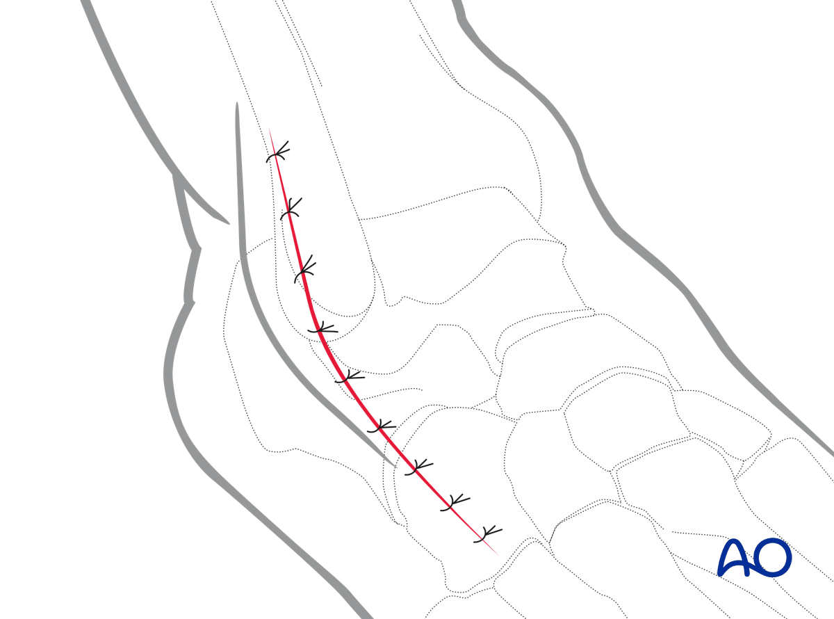 Anterolateral approach layered closure restoring anatomy after anterolateral talar approach