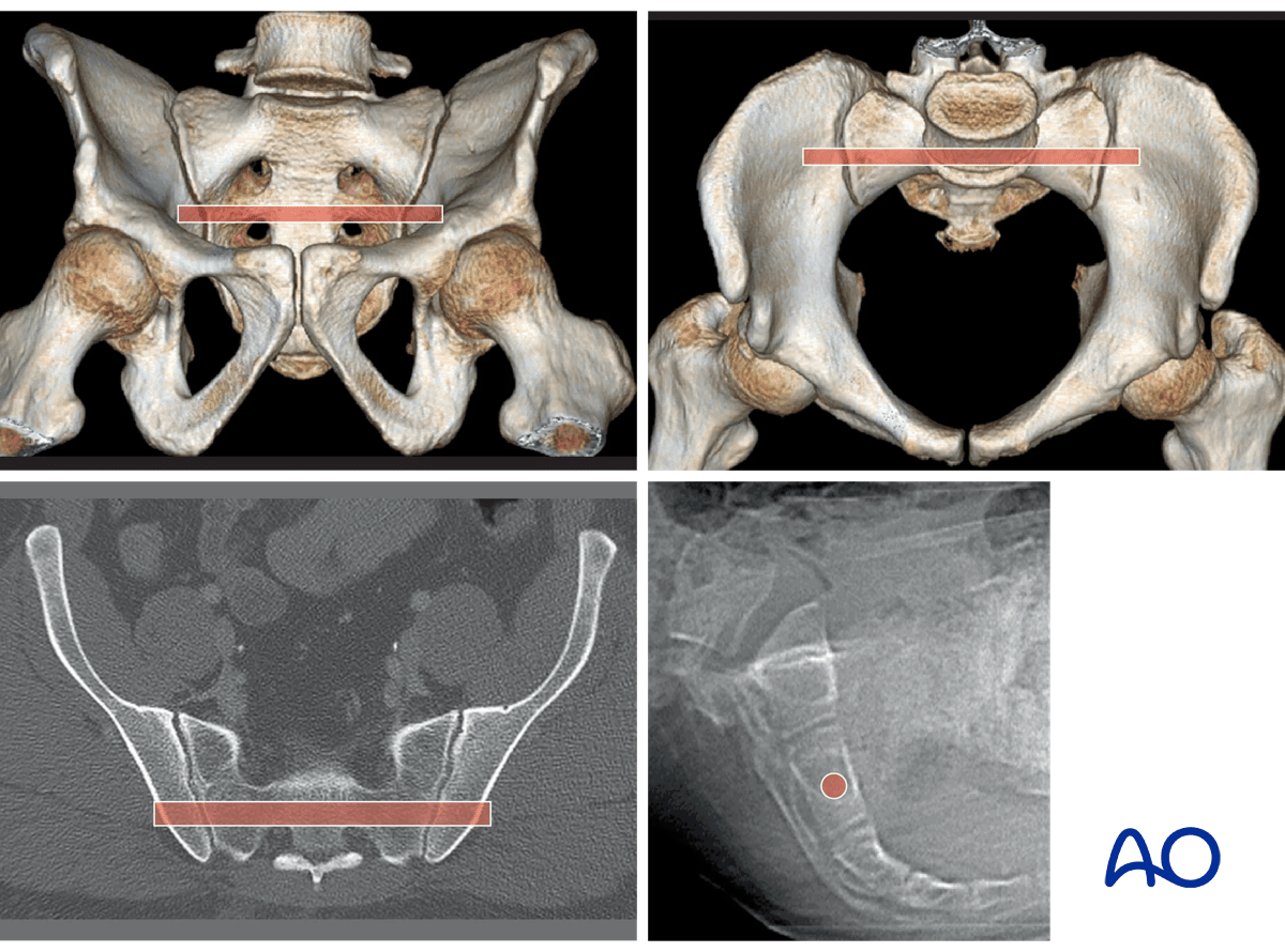 MIO iliosacral screw for sacrum