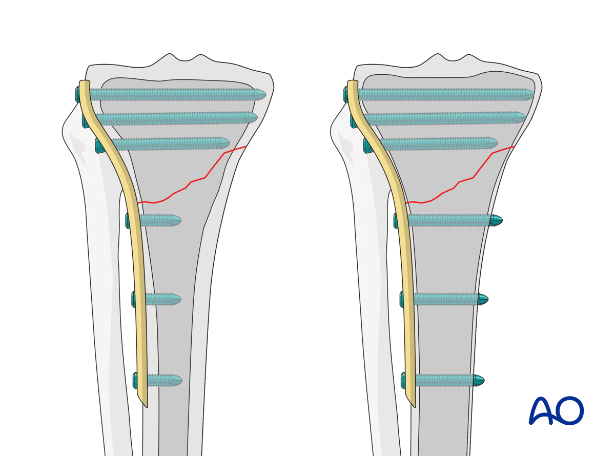 Proximal tibia: Simple extraarticular fracture of the metaphysis Angular stable plating -  preoperative planning
