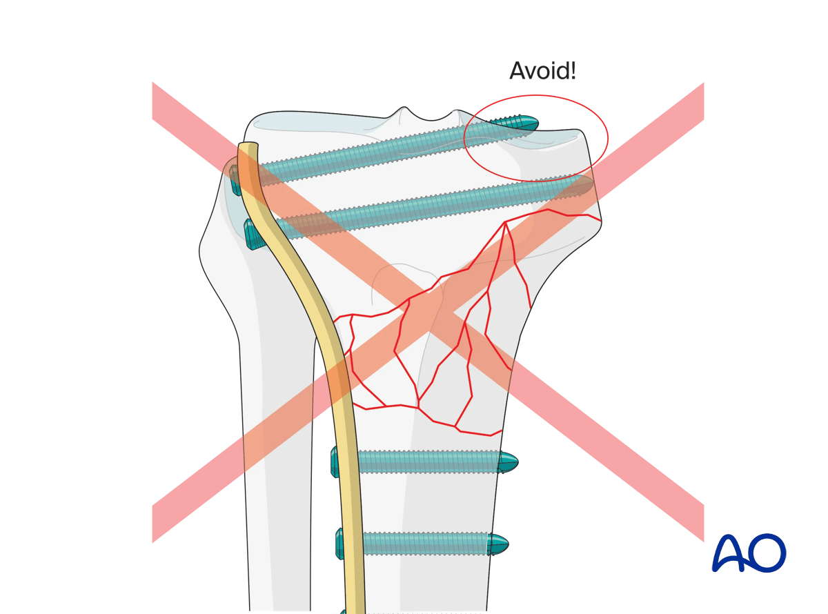 Proximal tibia: Wedge or multifragmentary extraarticular fracture Angular stable plating – plate positioning