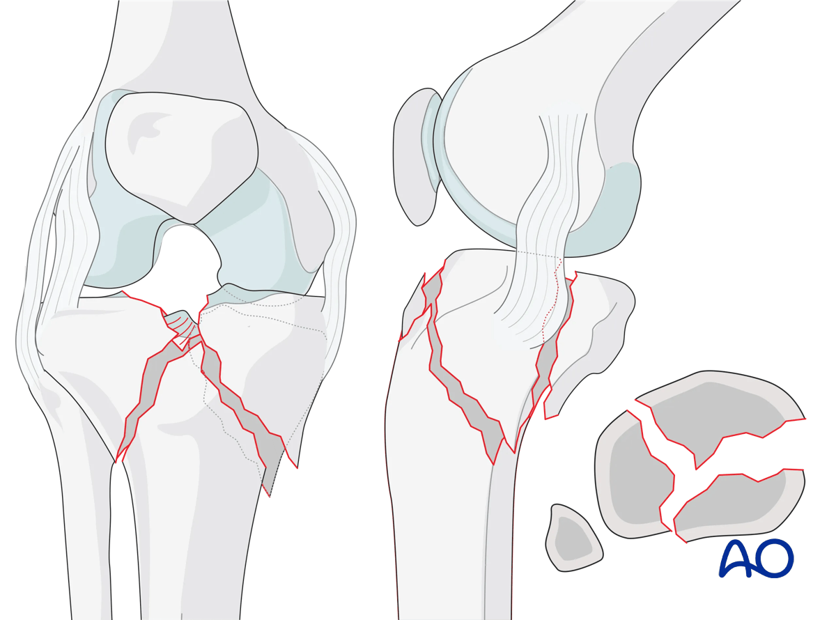Complete articular fracture with fragmentary medial plateau