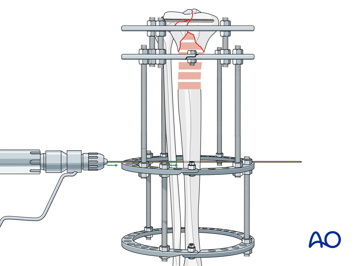 Proximal tibia fracture – ring fixation: insertion of temporary positioning wire