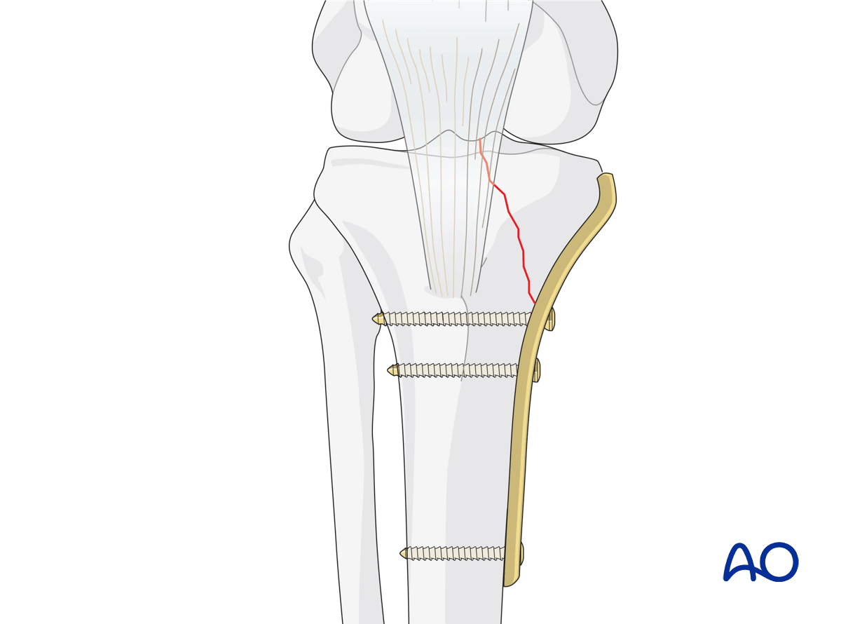 ORIF - Conventional plating, fixation of medial column