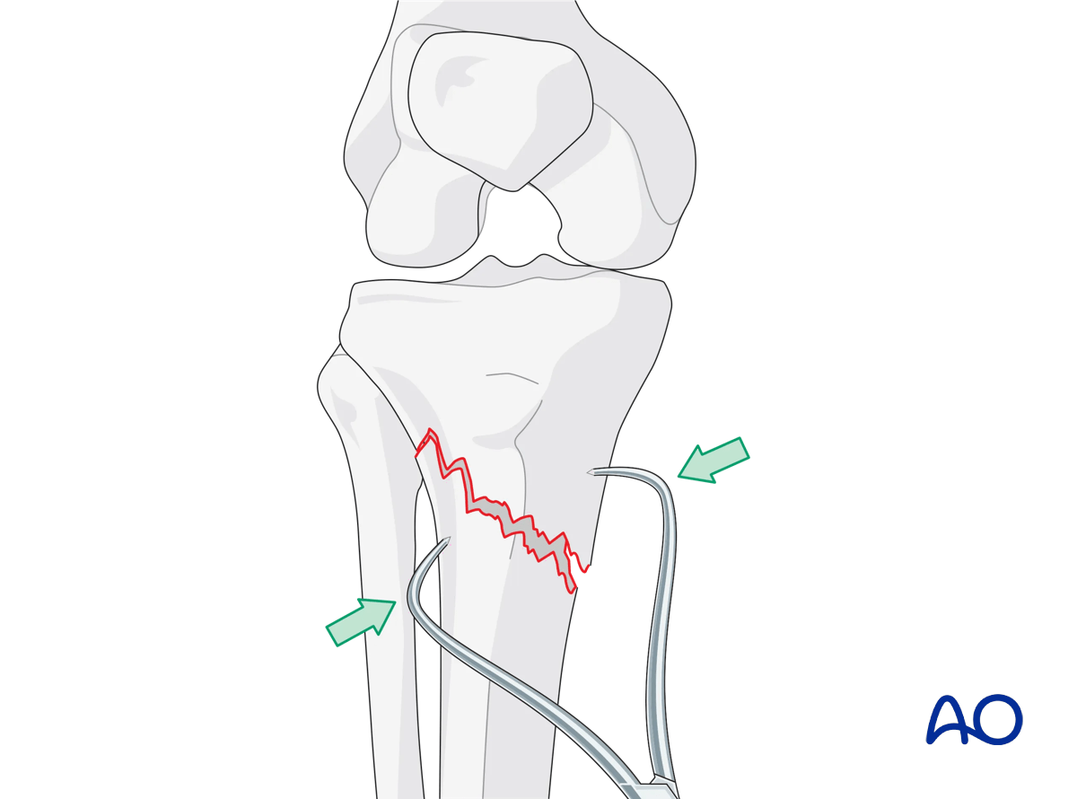 ORIF - Conventional plating, open reduction