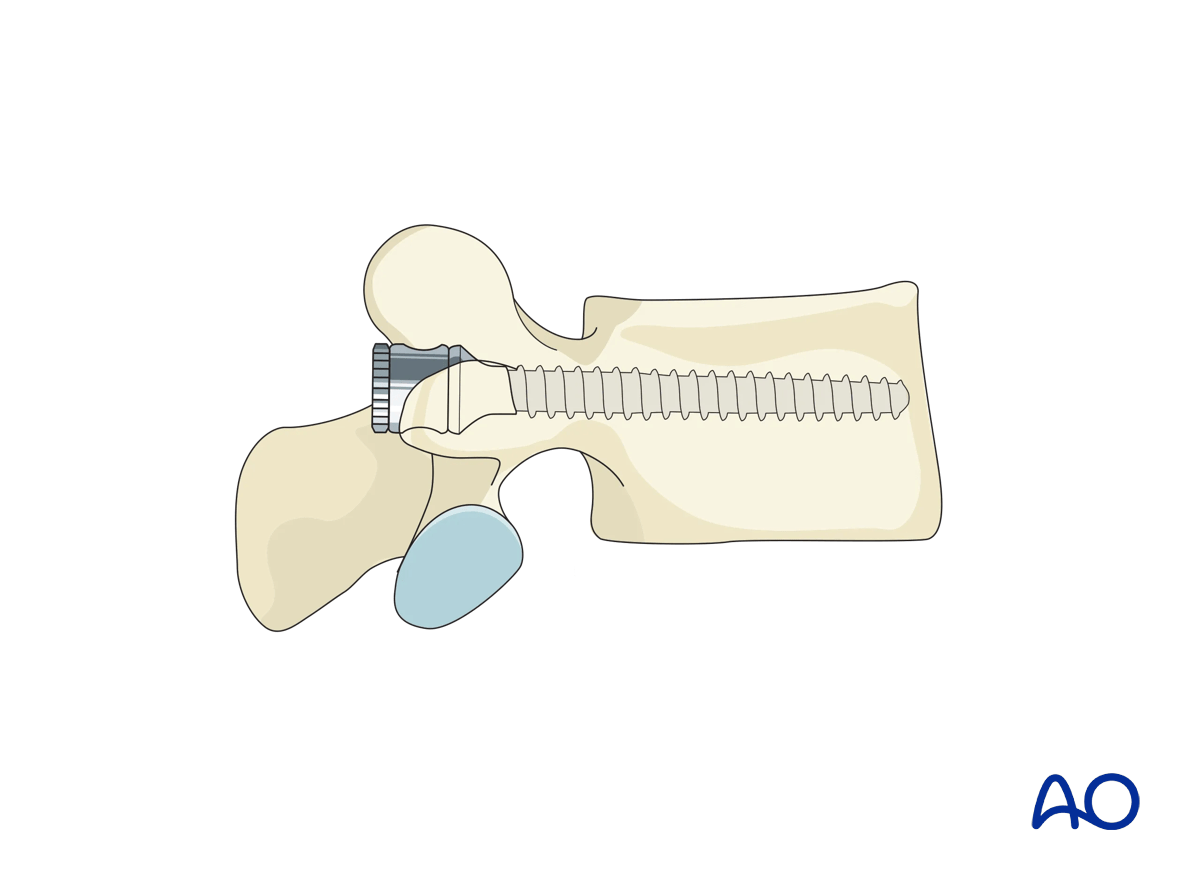 Pedicle screw insertion in the lumbar spine