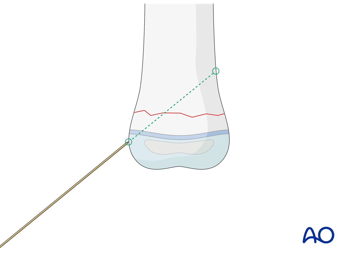 K-wire fixation of a transverse metaphyseal fracture in a pediatric patient