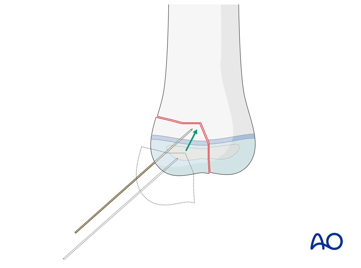 K-wire entry point
