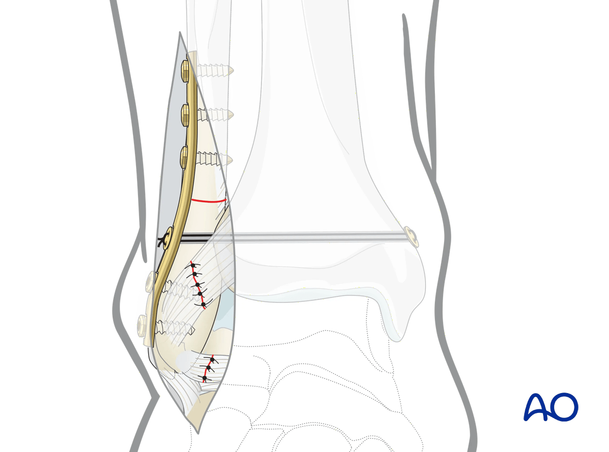 Lateral malleolar osteotomy syndesmotic stabilization with suture-button (tightrope) or screw may be required