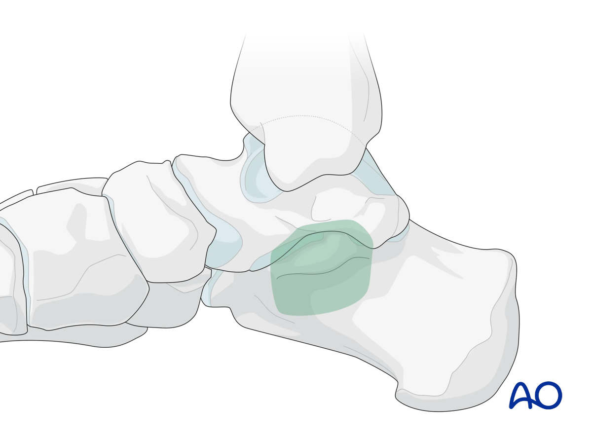 Areas of calcaneus visualized in medial approach to the calcaneus