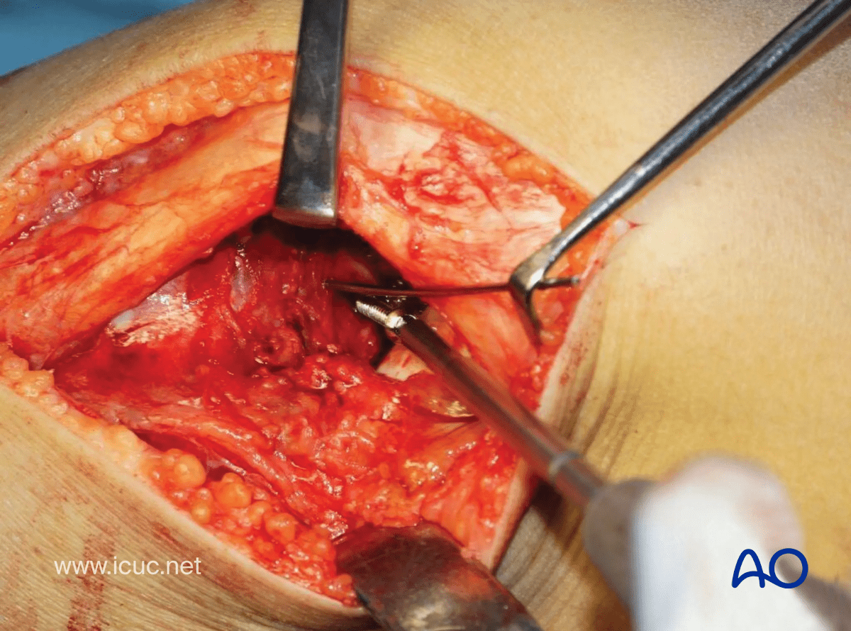Avulsion of tibial spine – A small fragment cancellous lag screw is inserted