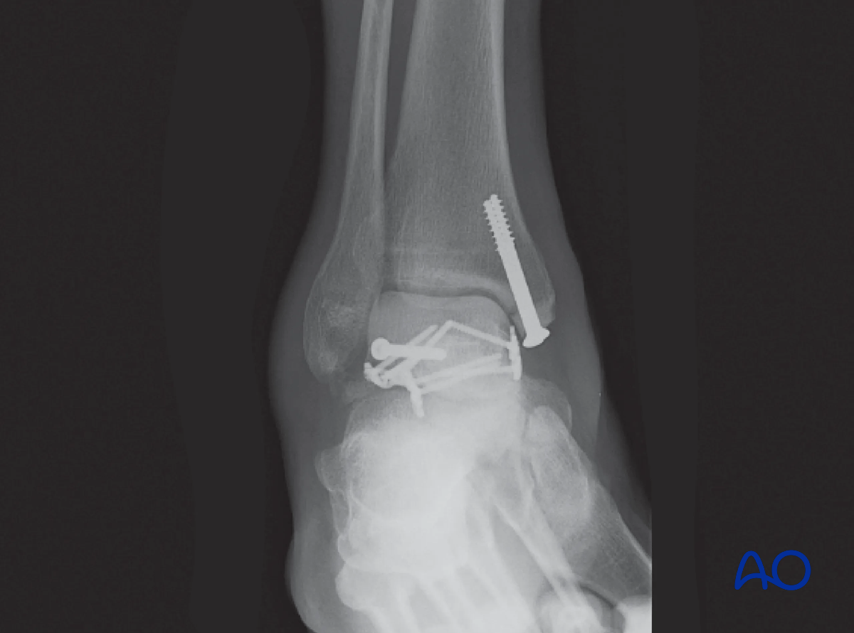 Medial malleolar osteotomy postop x-ray: talus fracture fixed via anteromedial osteotomy with lag screws.
