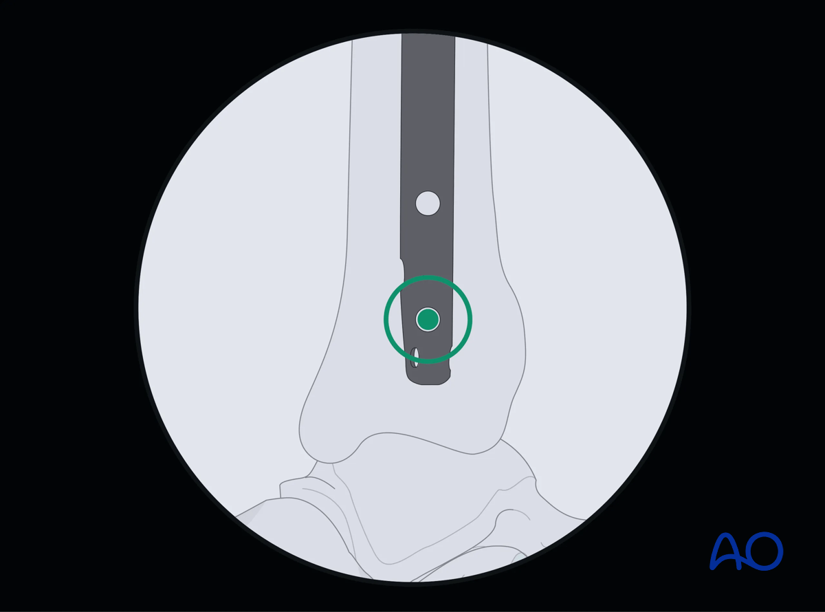 Suprapatellar intramedullary nailing, Distal interlocking with fluoroscopic guidance