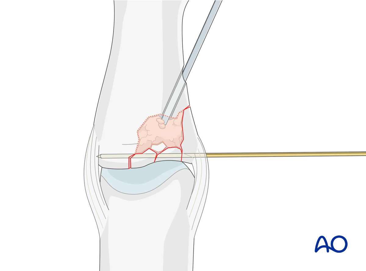 Joint reconstruction of lateral plateau fracture in middle phalangeal base, fill cavity with bone graft, confirm with image intensifier.