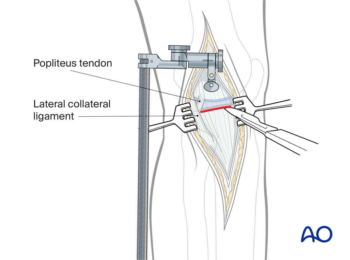 Anterolateral approach to the proximal tibia: arthrotomy