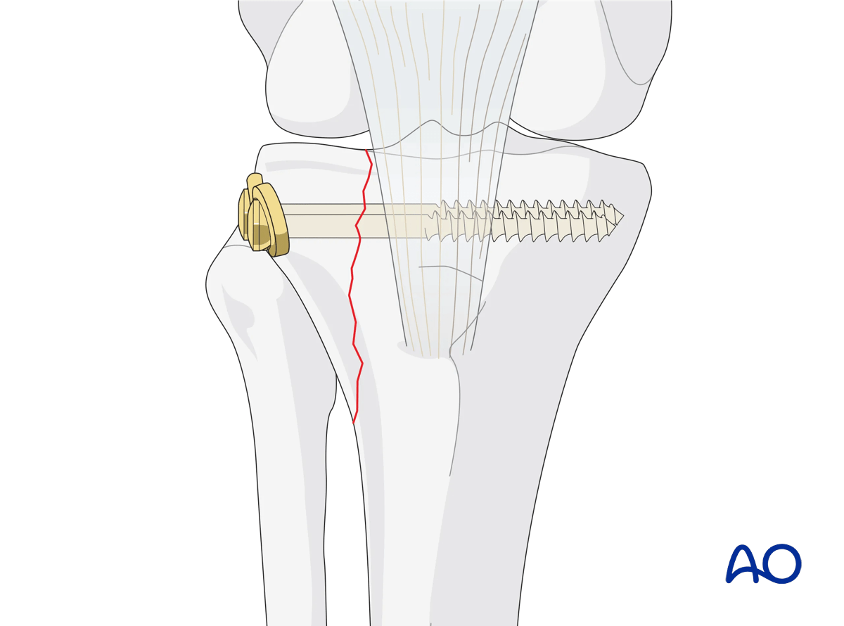 Proximal tibia lateral plateau split fracture with ORIF and lag screw fixation with washers