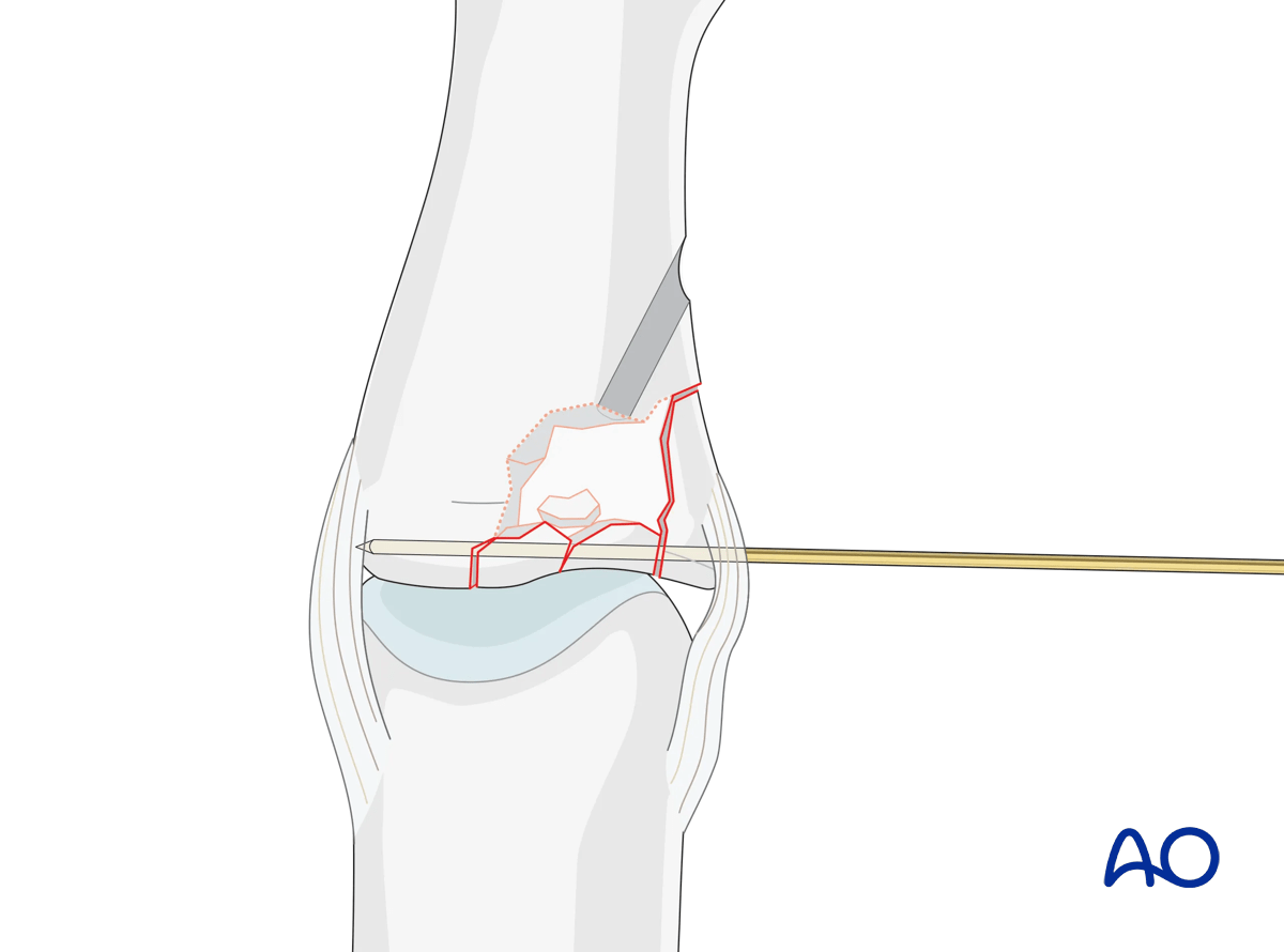 Joint reconstruction of lateral plateau fracture in middle phalangeal base, optional K-wire for stabilization until consolidation.