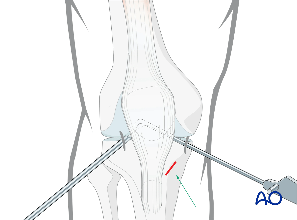Arthroscopic approach to the knee, Anteromedial incision