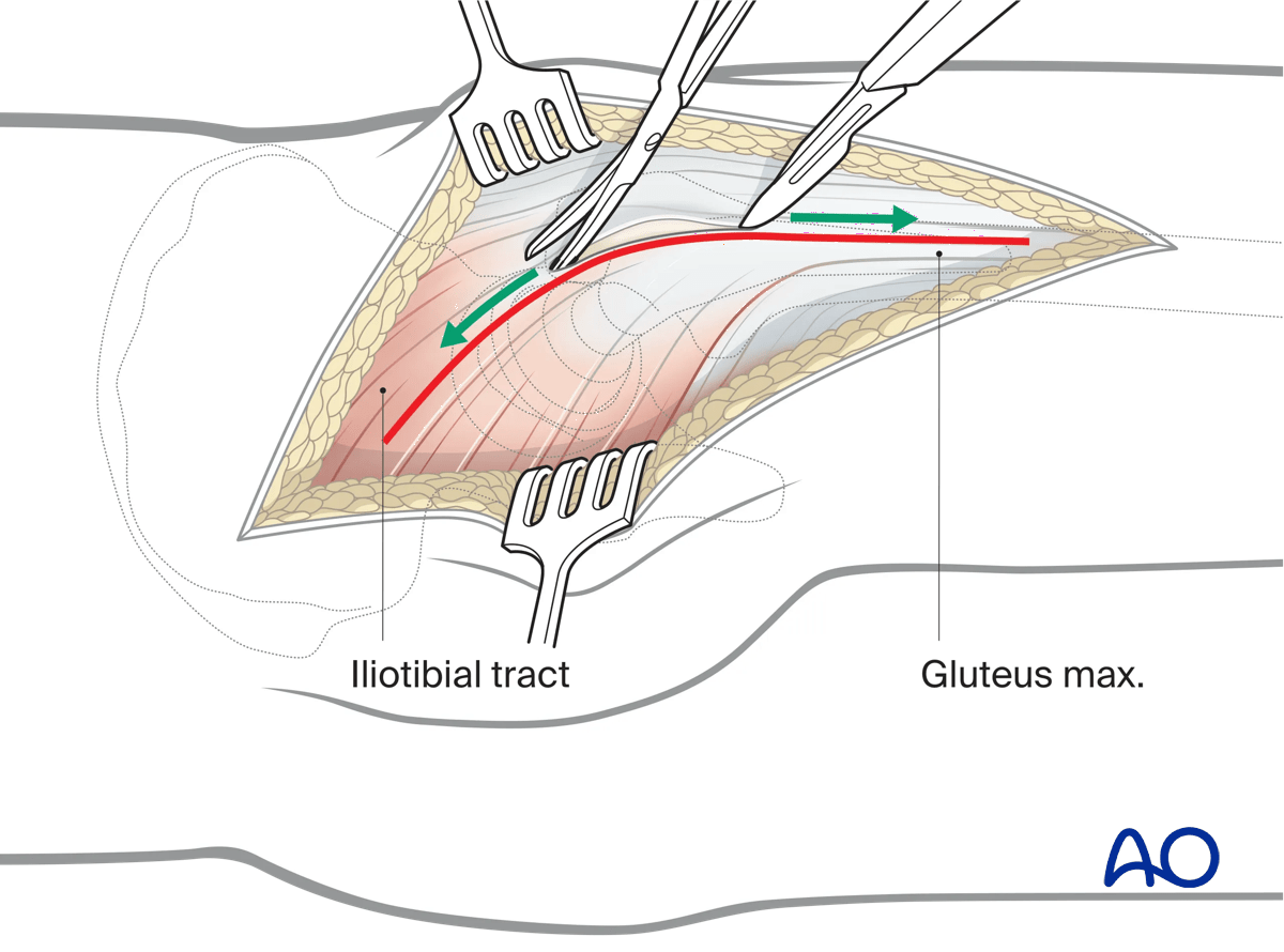 Fascial incision in a Kocher-Langenbeck approach to the hip