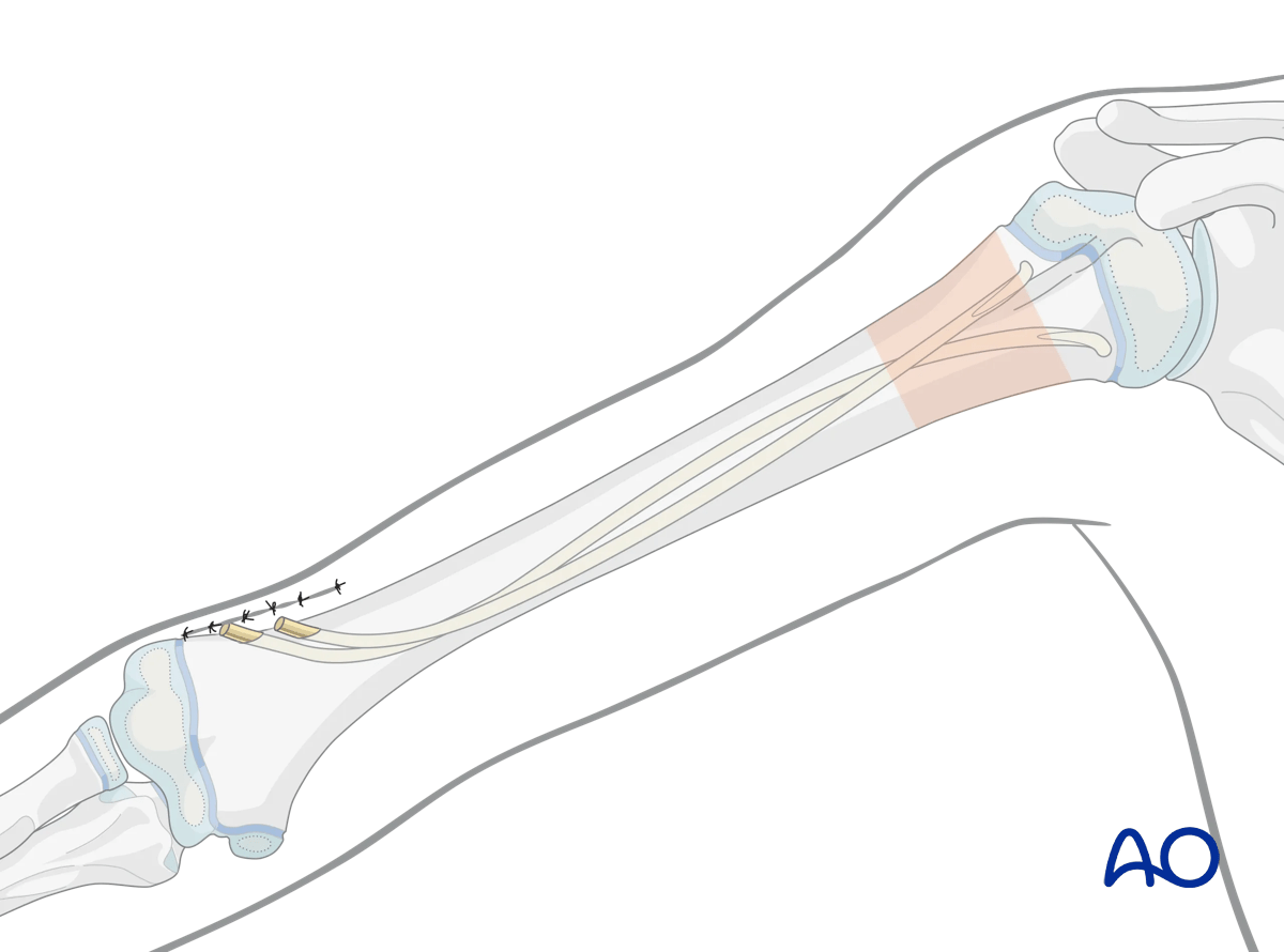 Retrograde elastic nailing of a proximal simple transverse humeral shaft fracture in a pediatric patient