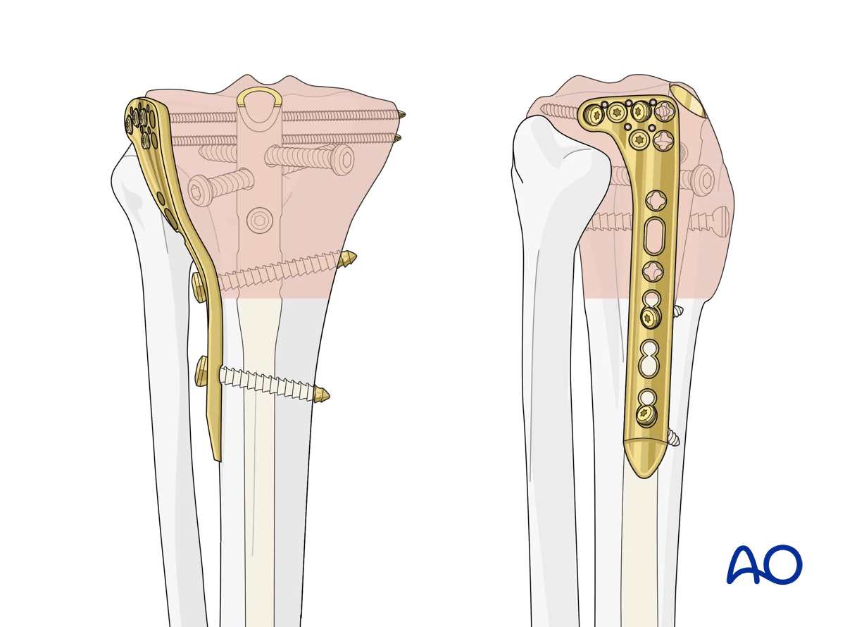 Intramedullary nailing for proximal tibia fractures
