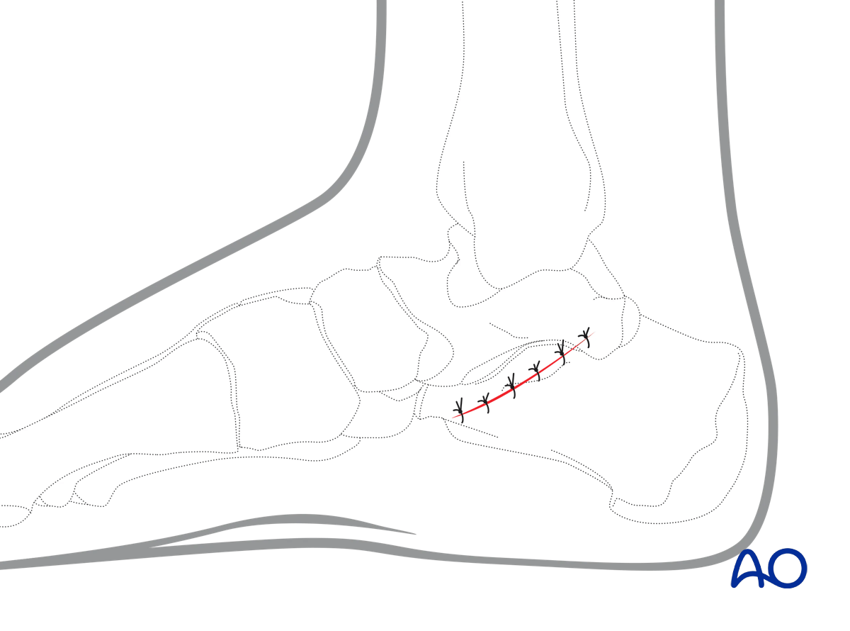 Wound closure sutures in medial approach to the calcaneus