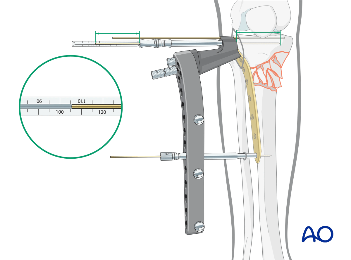 Proximal tibia: Wedge or multifragmentary extraarticular fracture Angular stable plating – finalized reduction