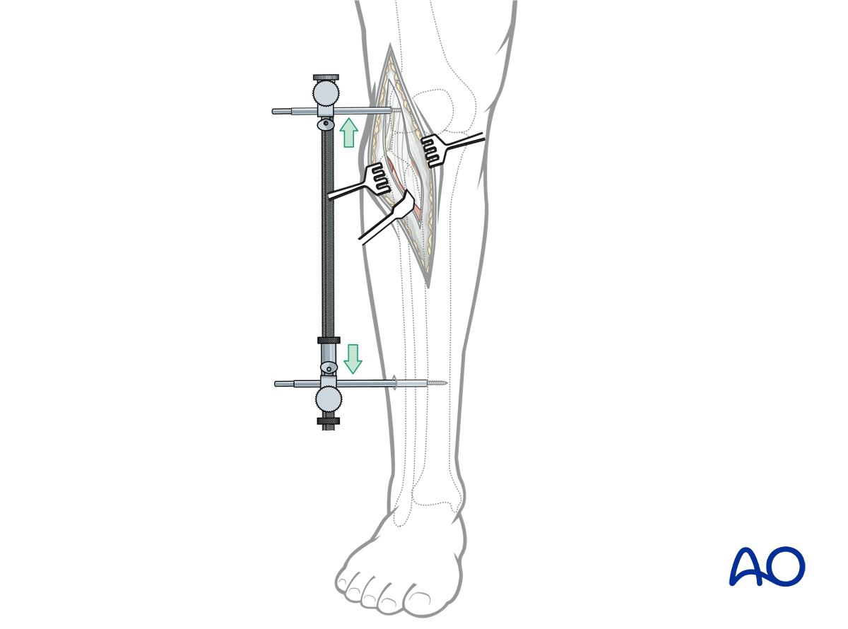 Anterolateral approach to the proximal tibia: opening the joint
