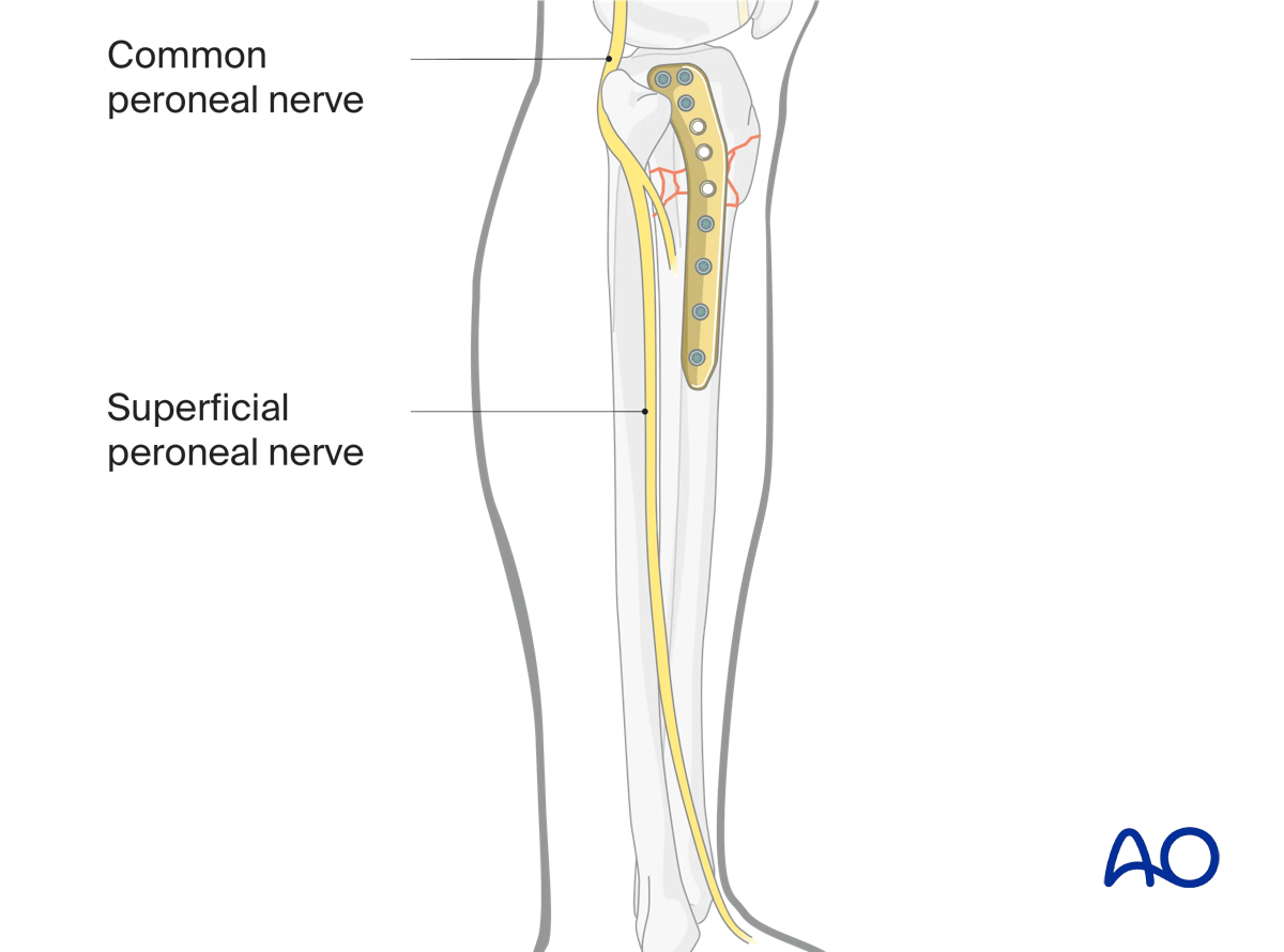 Proximal tibia: Wedge or multifragmentary extraarticular fracture Angular stable plating – atomic hazards