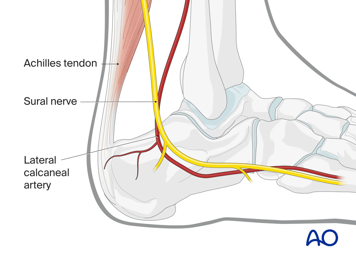 Posterolateral approach hindfoot posterior calcaneal approach preserving Achilles tendon, sural nerve, and lateral calcaneal artery.