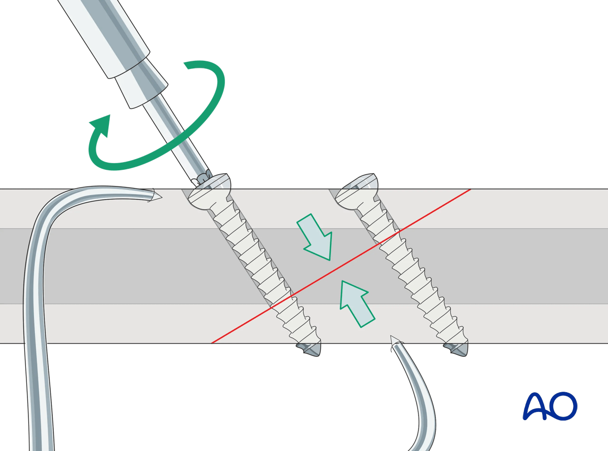 Insertion of a second lag screw in a long oblique fracture