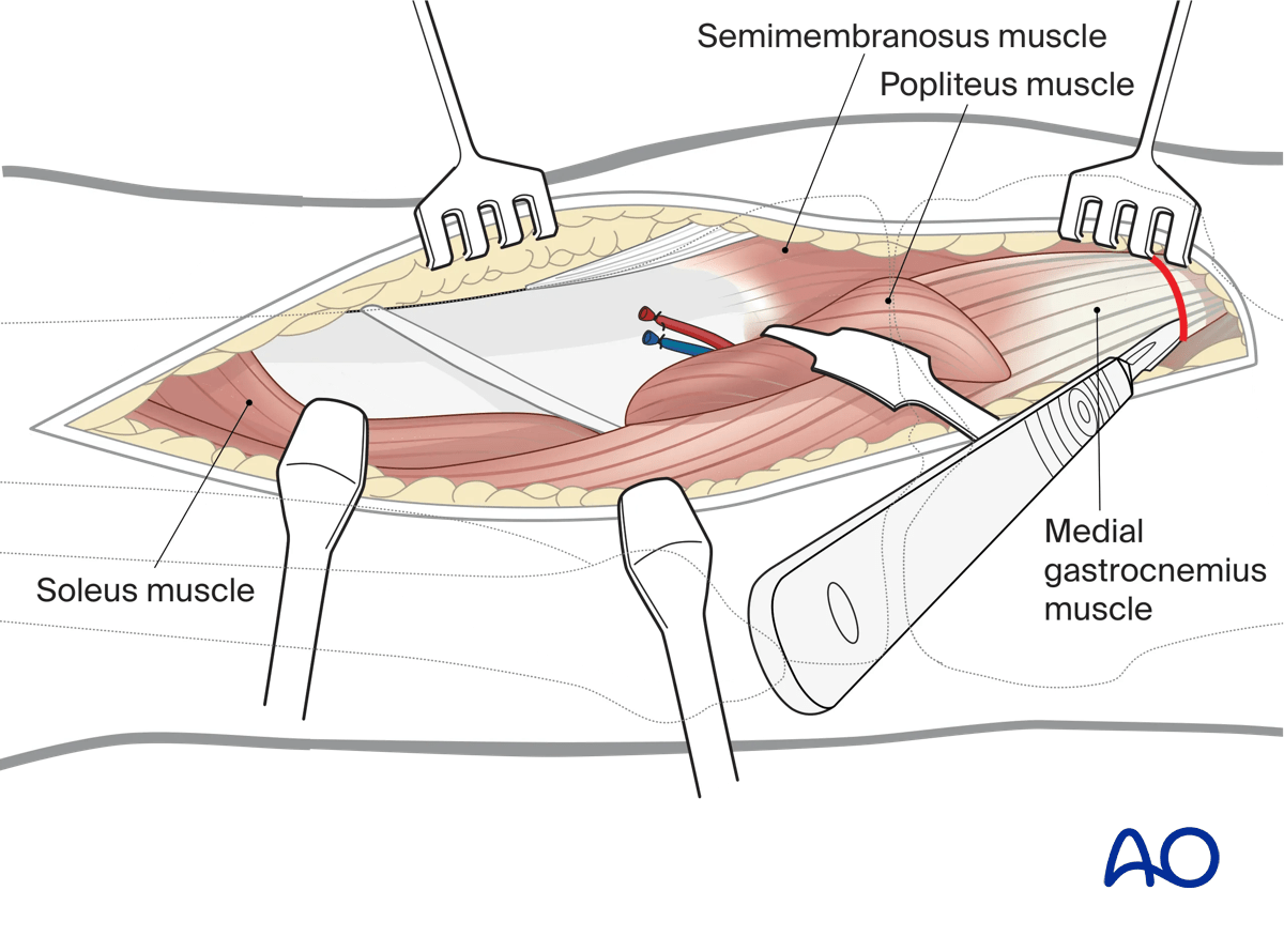Prone posteromedial approach to the proximal tibia, deep dissection