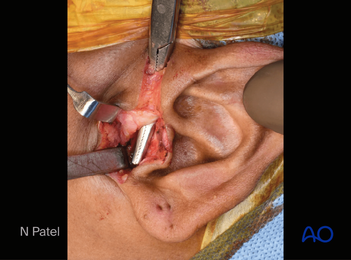 Endaural approach to condyle: Develop a tunnel connecting both parts of the incision
