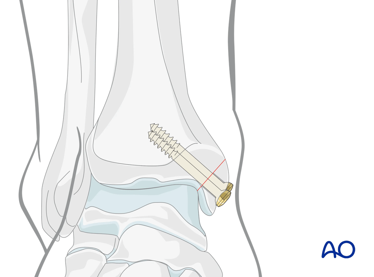 Medial malleolar osteotomy reduce medial malleolus and fix with lag screws; antiglide plate for vertical osteotomy.