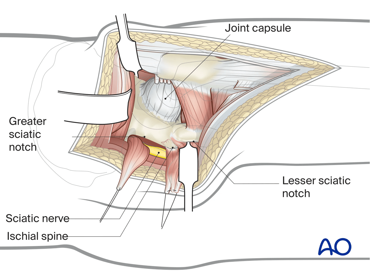 Exposure of the posterior wall and column in a Kocher-Langenbeck approach to the hip