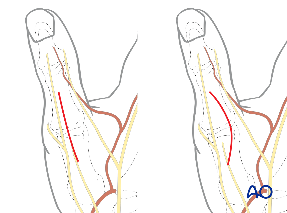 Dorsal approach to the MCP joint of the thumb