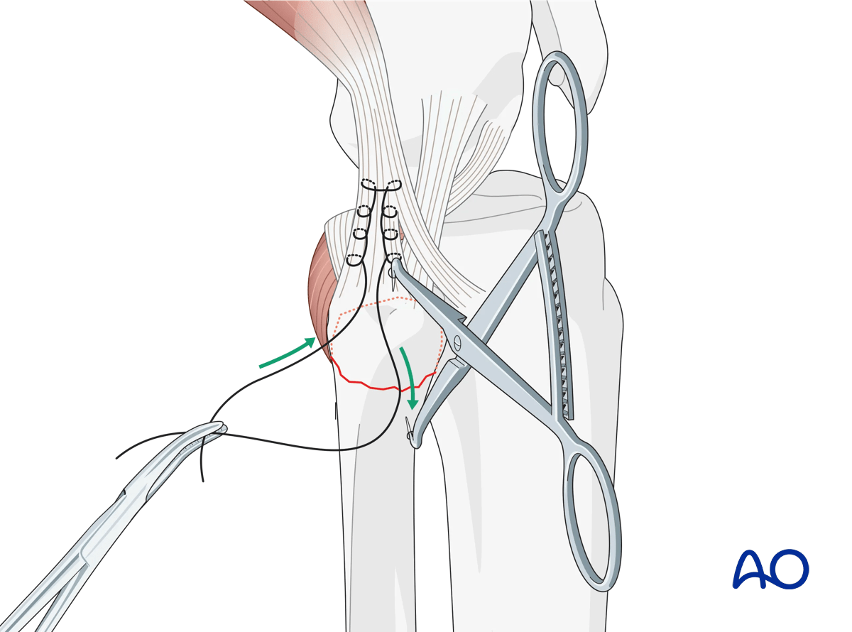 Extraarticular avulsion of fibular head: fixation