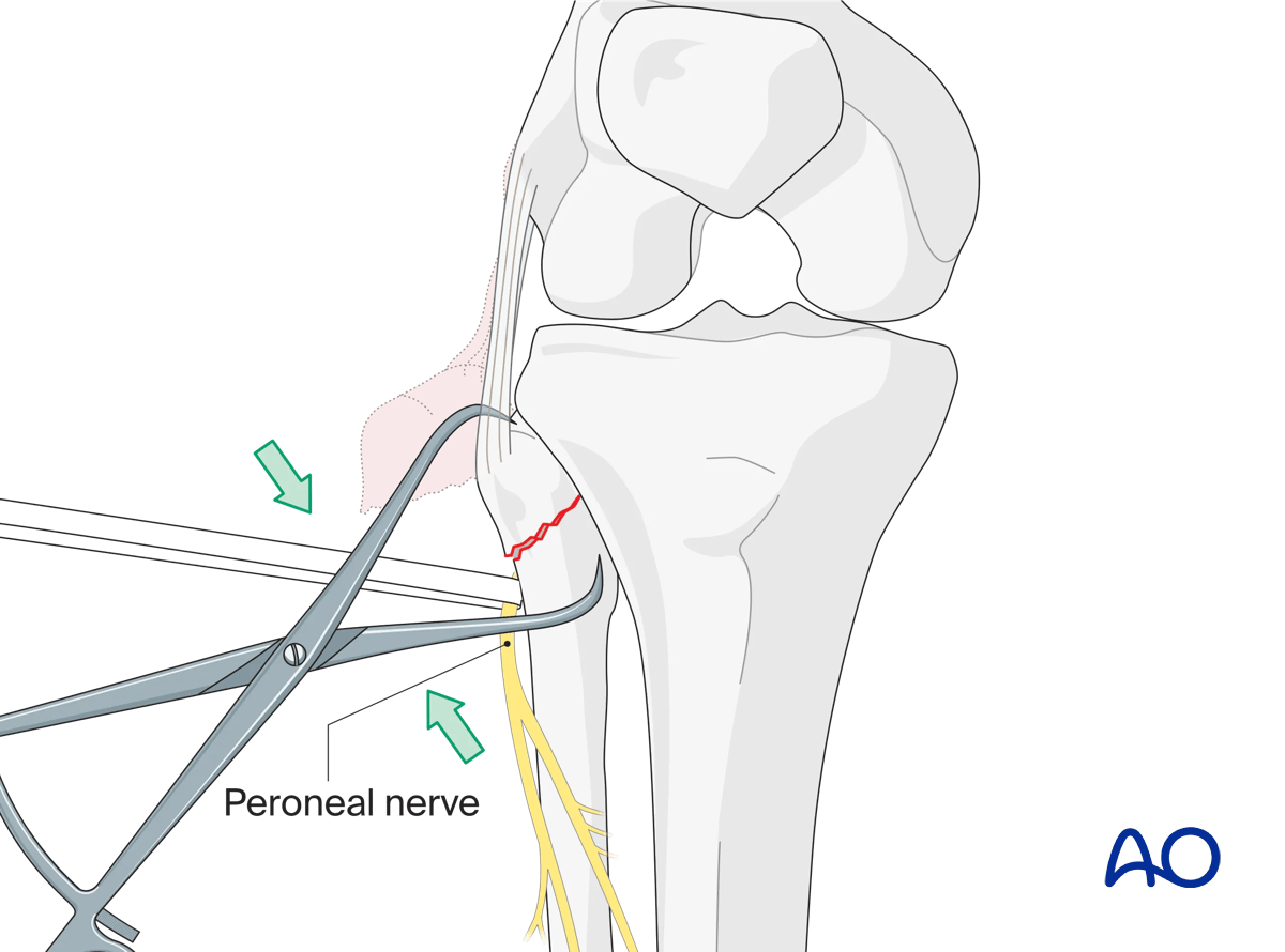 Extraarticular avulsion of fibular head: preliminary reduction
