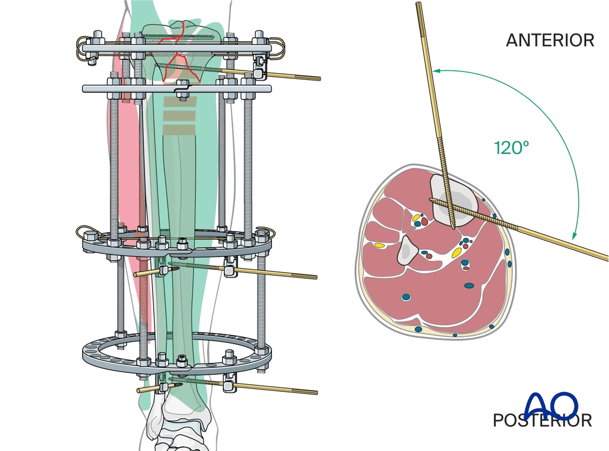 Proximal tibia fracture – ring fixation: fixation of diaphyseal fixation block
