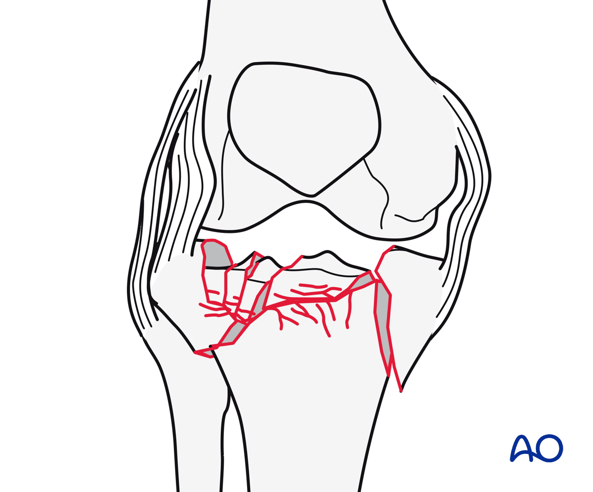 Proximal tibia: Complete articular fracture with fragmentary lateral plateau