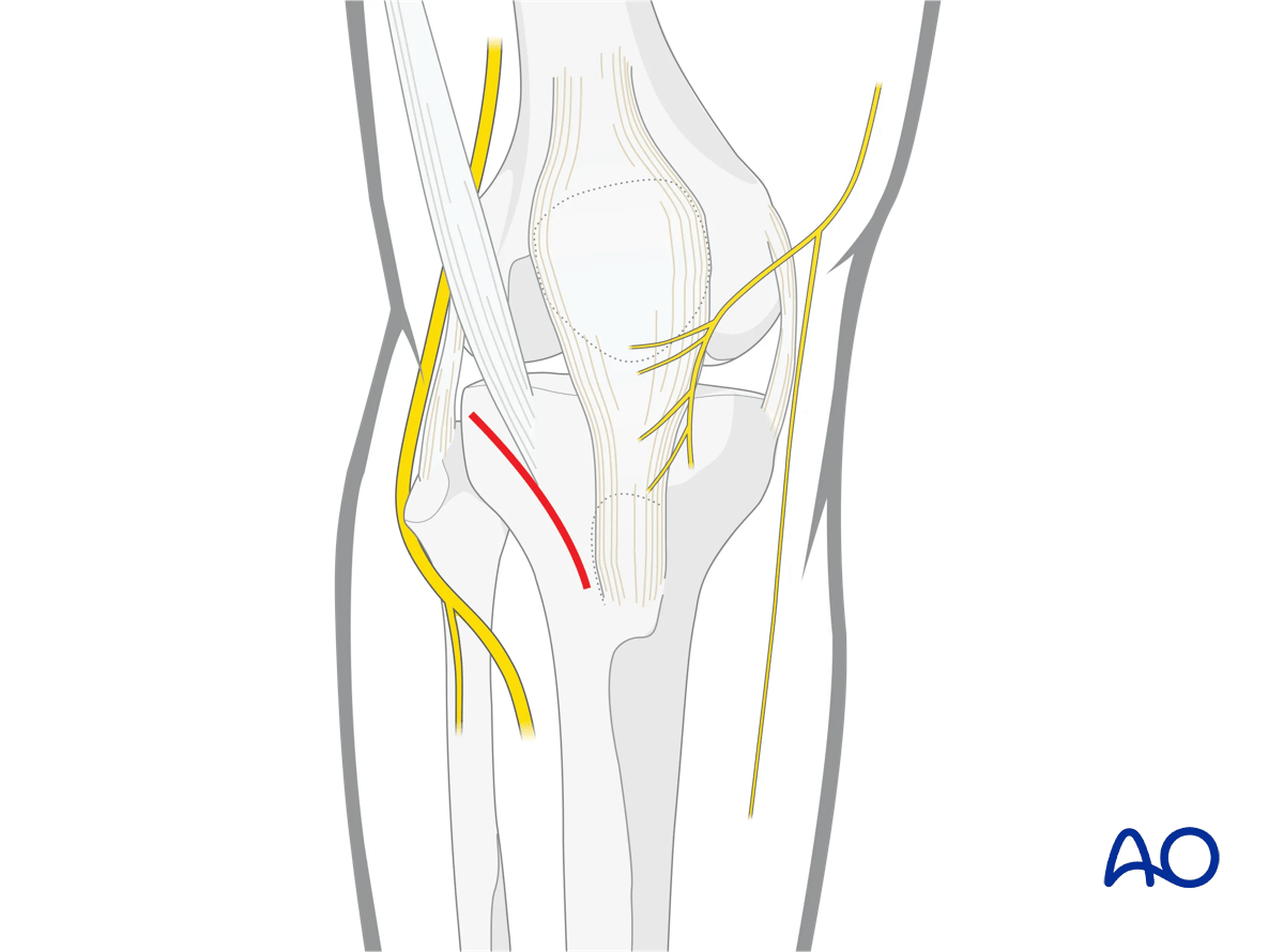 Approach for minimally invasive osteosynthesis (MIO) of the proximal tibia, skin incision