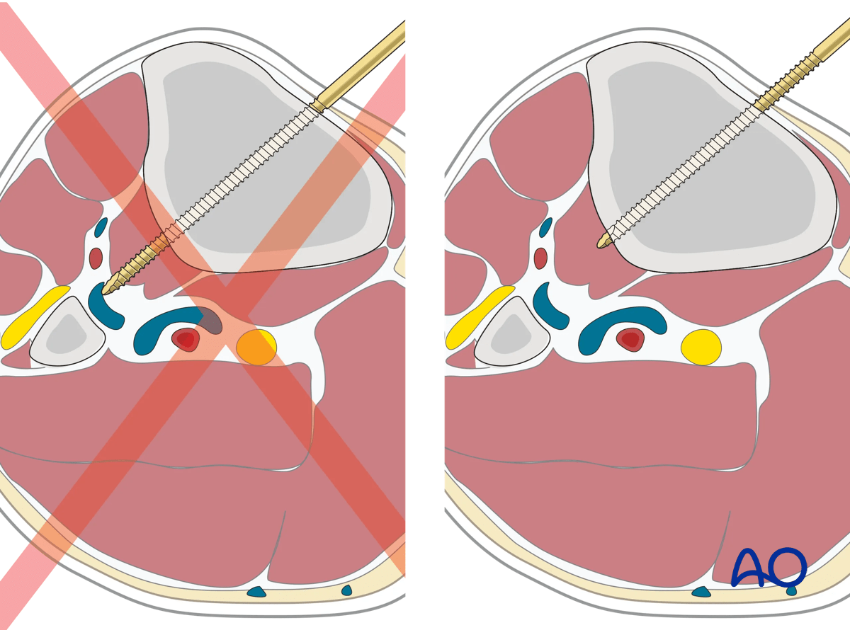 Proximal tibia fracture – ring fixation: care must be taken not to over insert Schanz screws