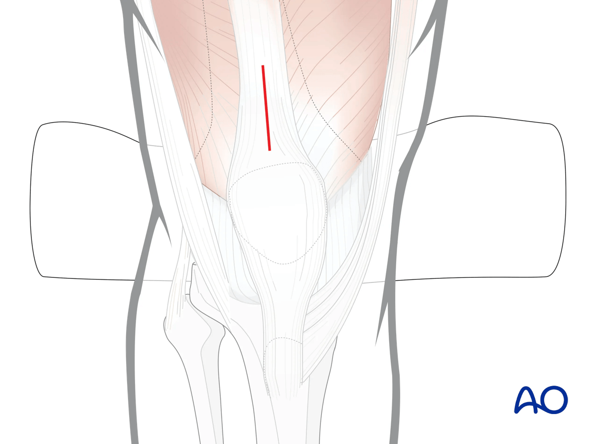 Semi-extended suprapatellar approach for intramedullary nailing