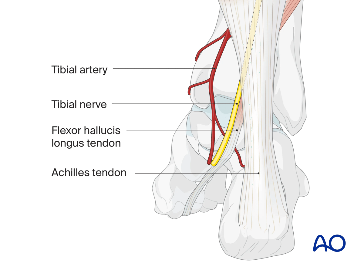 Posteromedial talus approach plane between FHL and Achilles; neurovascular bundle behind medial malleolus protected