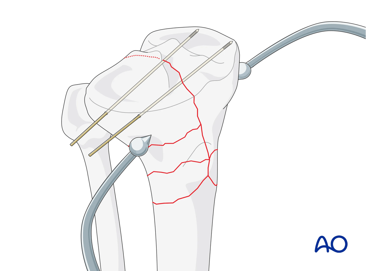Complete simple articular fracture with fragmentary metaphyseal components: secure reduction