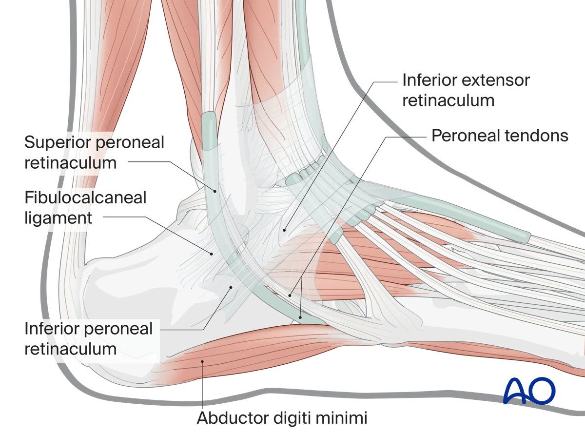Sinus tarsi approach to the calcaneus showing peroneal tendons, retinaculum, and lateral collateral ligament